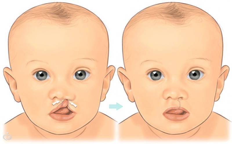 Расщелина неба у новорожденного фото с пояснениями