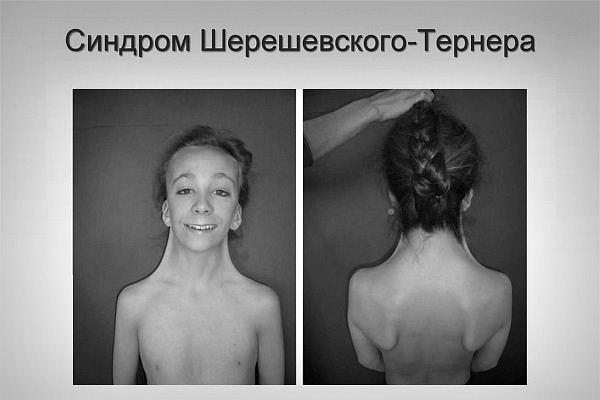 Синдром мея тернера. Синдром Шерешевского Тернера УЗИ. Шерешевского Тернера фото.